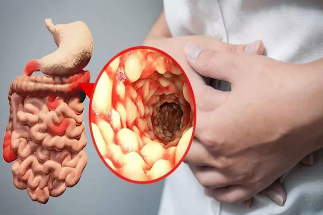 قبل ظهور الأعراض بعشر سنوات..
العلماء يكتشفون إشارات مبكرة لأمراض الأمعاء